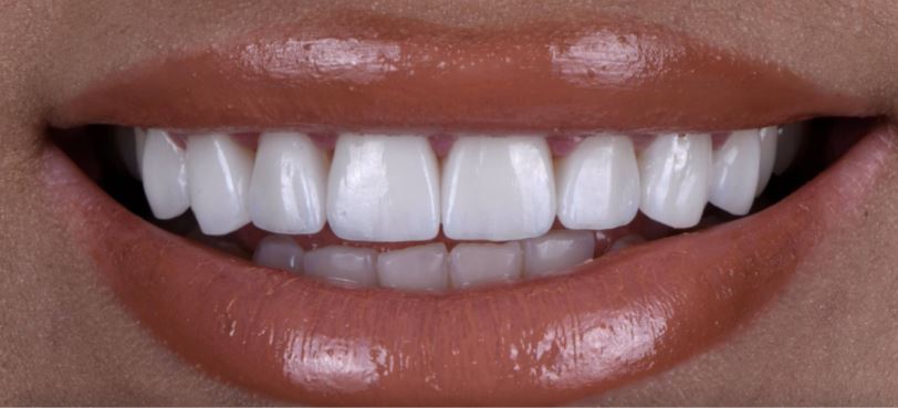 Porcelain veneers after treatment results - Best Dental Richmond TX patient 5