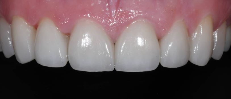 Porcelain veneers after treatment results - Best Dental Richmond TX patient 6