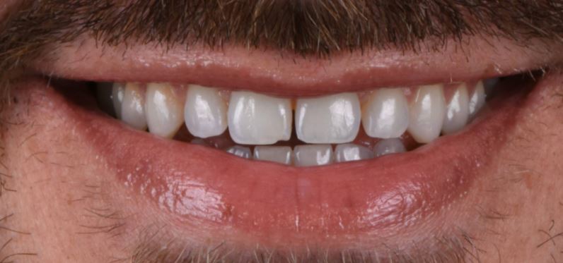 Porcelain veneers before treatment - Best Dental Richmond TX patient 1