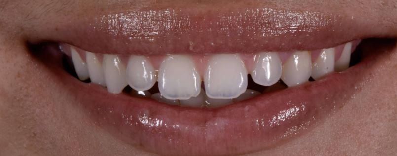 Porcelain veneers before treatment - Best Dental Richmond TX patient 2
