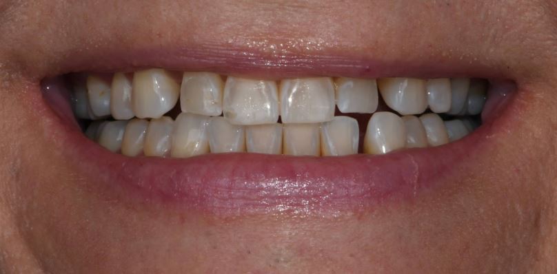 Porcelain veneers before treatment - Best Dental Richmond TX patient 3