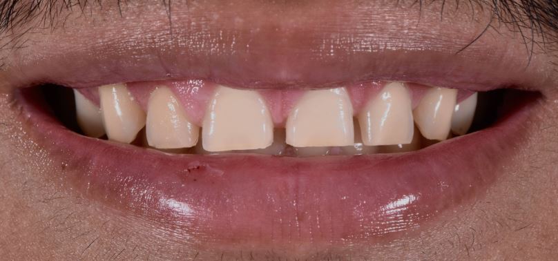 Porcelain veneers before treatment - Best Dental Richmond TX patient 4