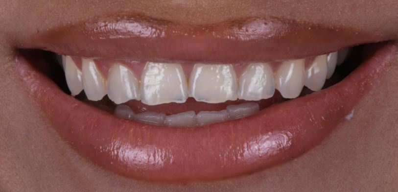 Porcelain veneers before treatment - Best Dental Richmond TX patient 5