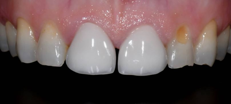 Porcelain veneers before treatment - Best Dental Richmond TX patient 6
