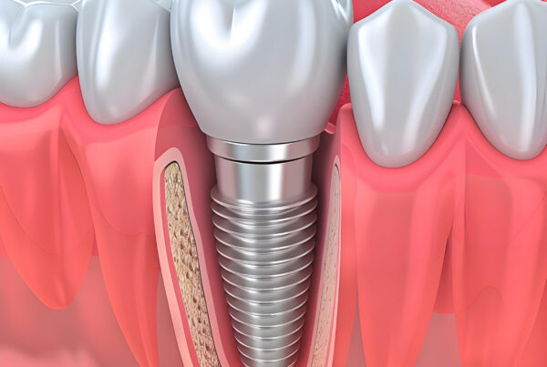 How To Replace A Tooth Without A Dental Bridge
