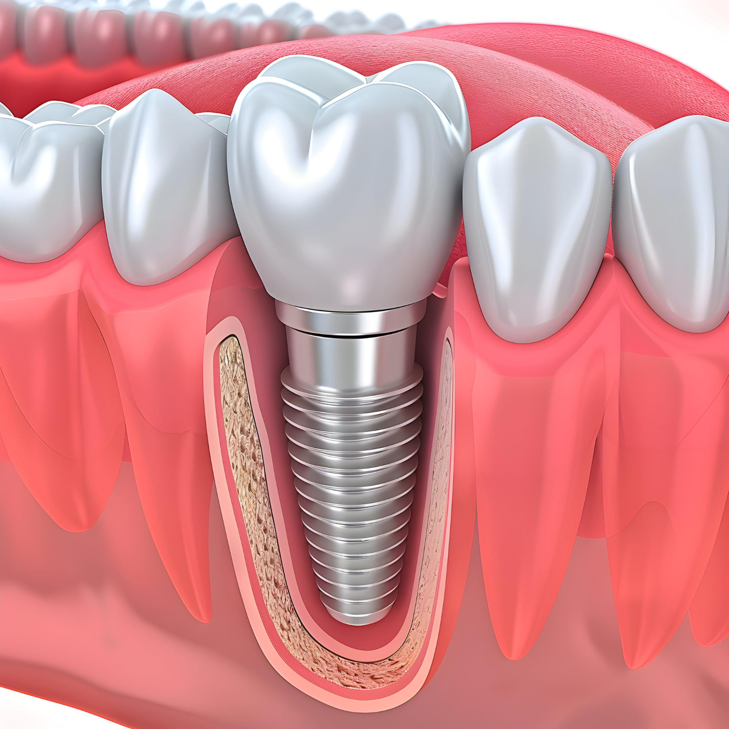 How To Replace A Missing Tooth Without A Dental Bridge