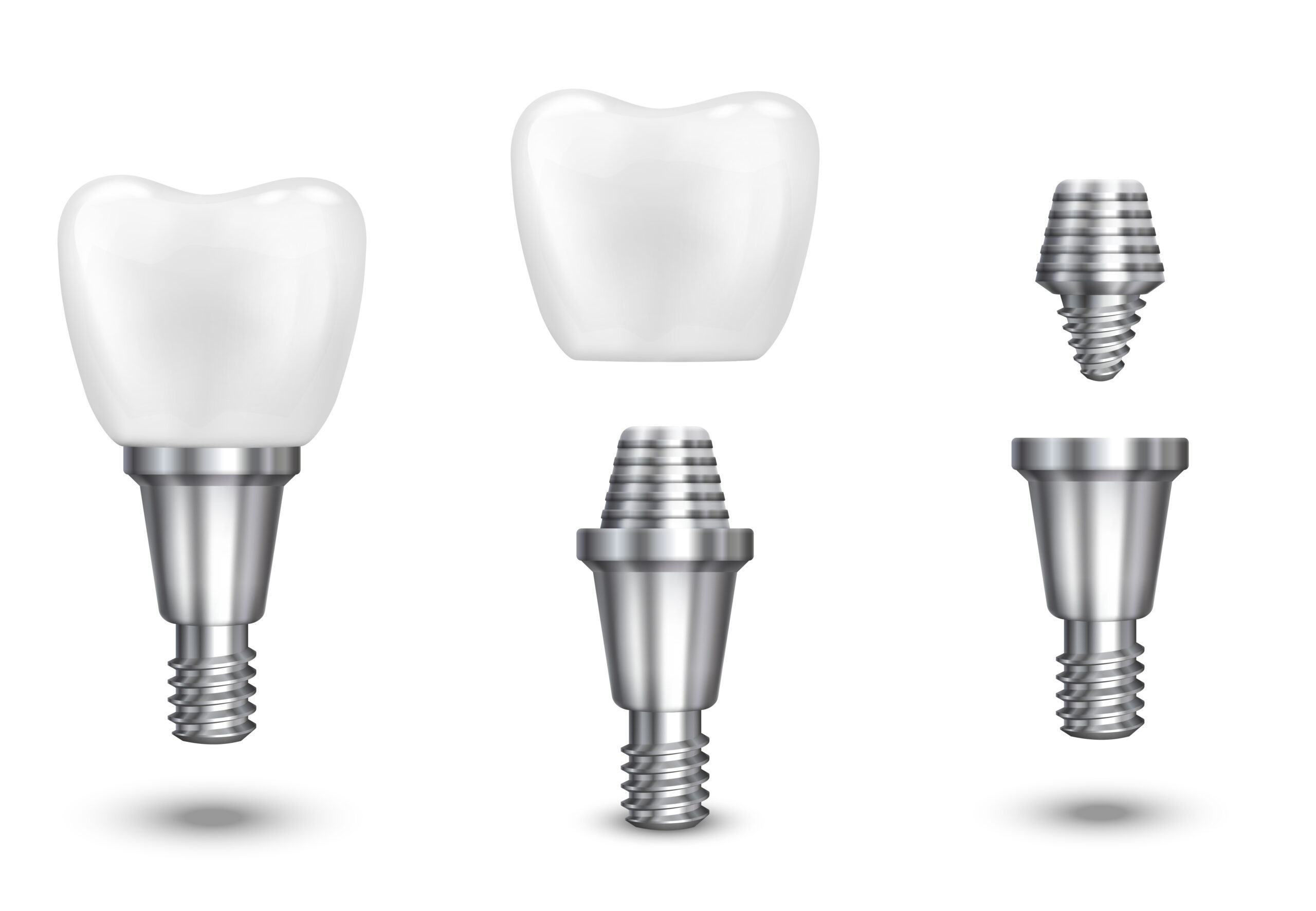 Dental implant components shown in detail: titanium implant post, abutment, and porcelain crown