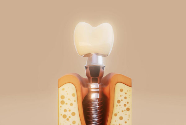 Are Dental Implants Worth It? | Best Dental Richmond, TX