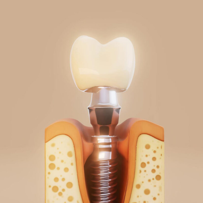 Are Dental Implants Worth It? | Best Dental Richmond, TX
