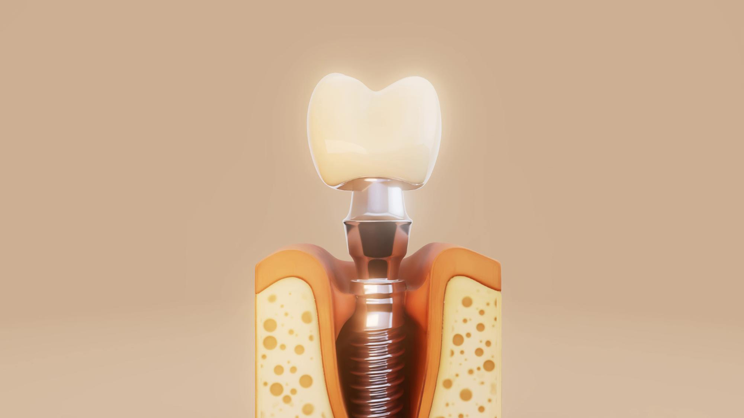Are Dental Implants Worth It?