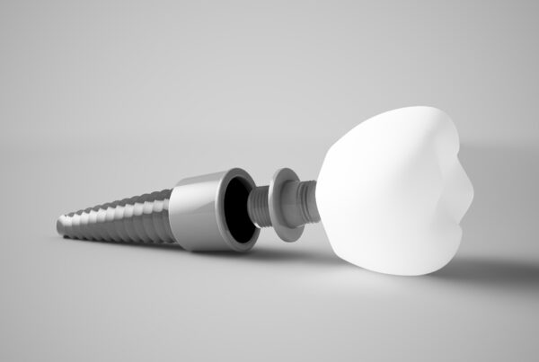 How Long Do Dental Implants Last?