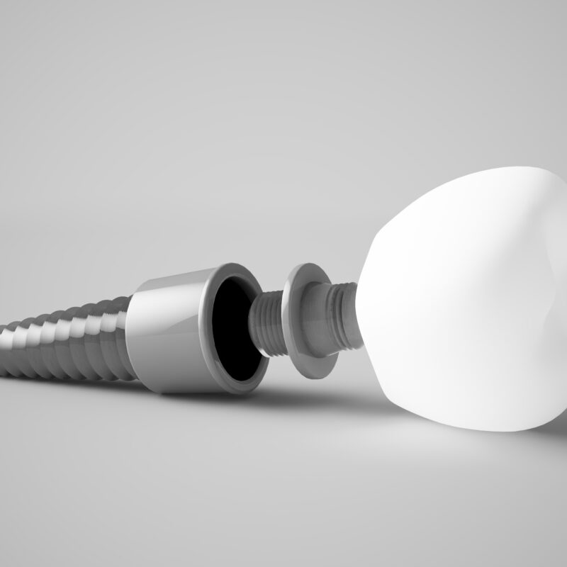 How Long Do Dental Implants Last?