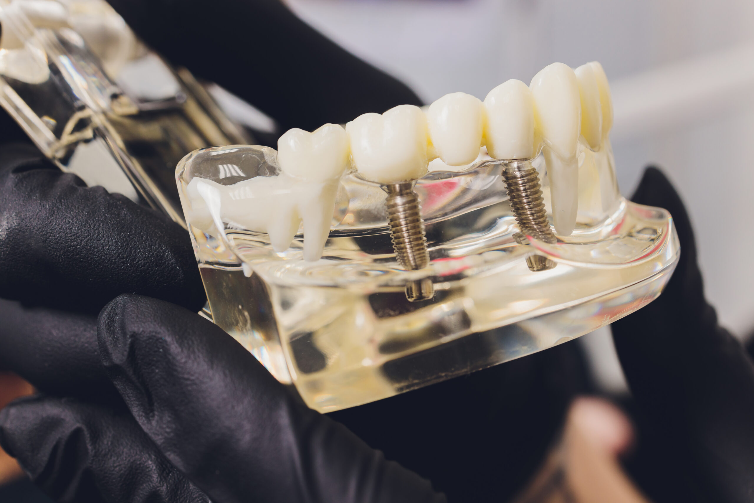Patient receiving dental implant at Best Dental in Richmond TX with long-term lifespan expectations