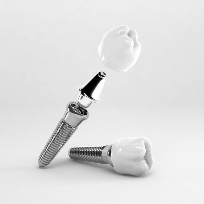 Non-Surgical Dental Implants Near Me | Houston, TX - Best Dental